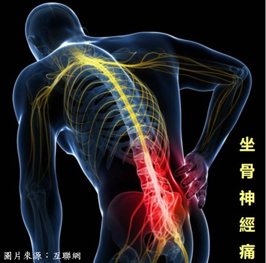 坐骨神經痛症可大可小
