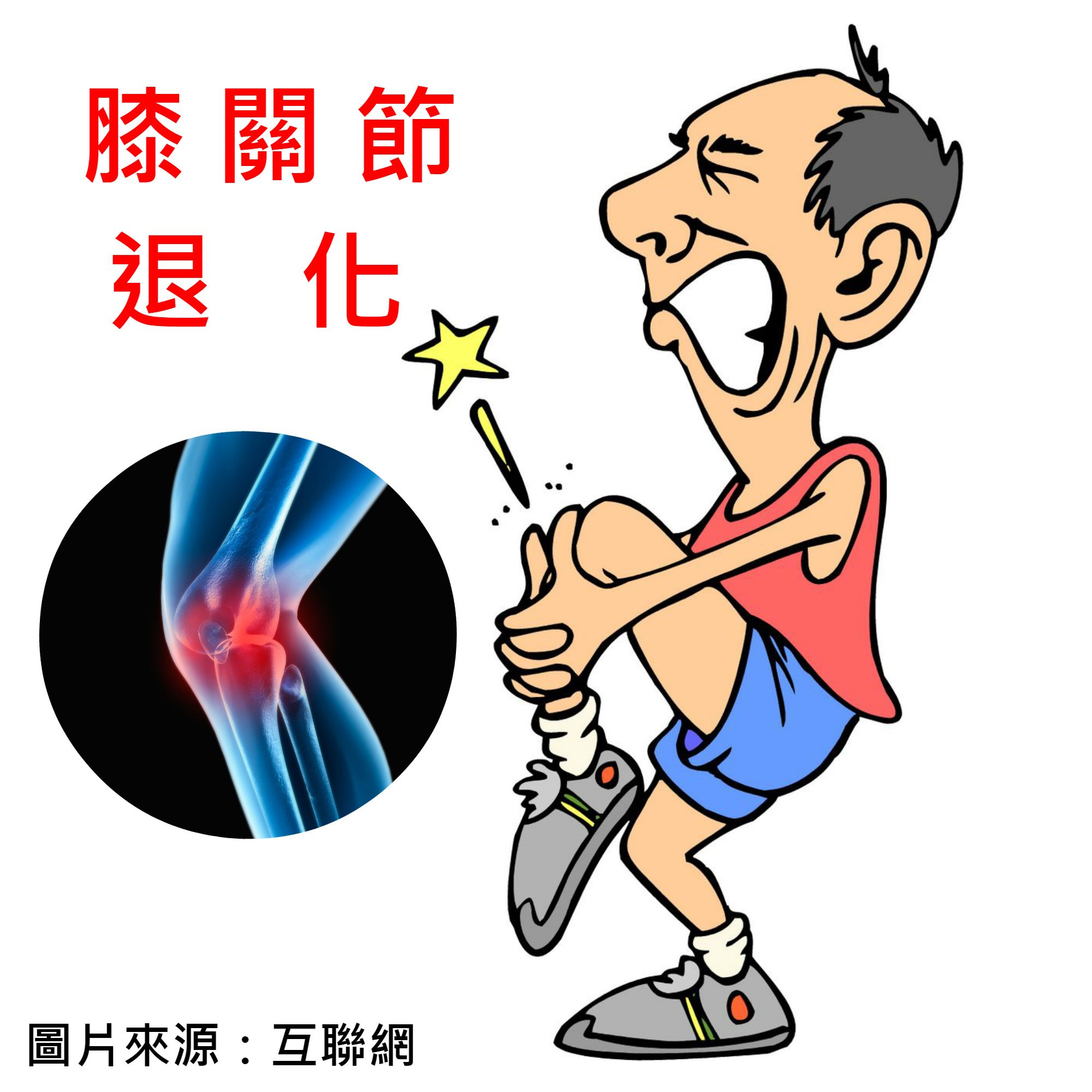 膝关节退化时的表现是觉得膝盖酸痛,乏力,当做运动屈伸膝关节或上下